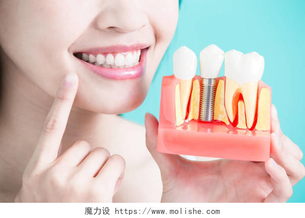 牙种植体模型牙齿美白口腔牙齿口腔牙齿